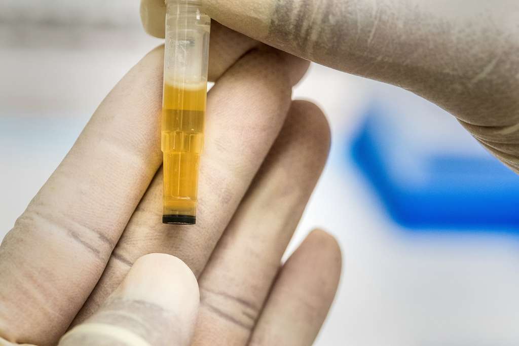 Urine sample in a vial for testing